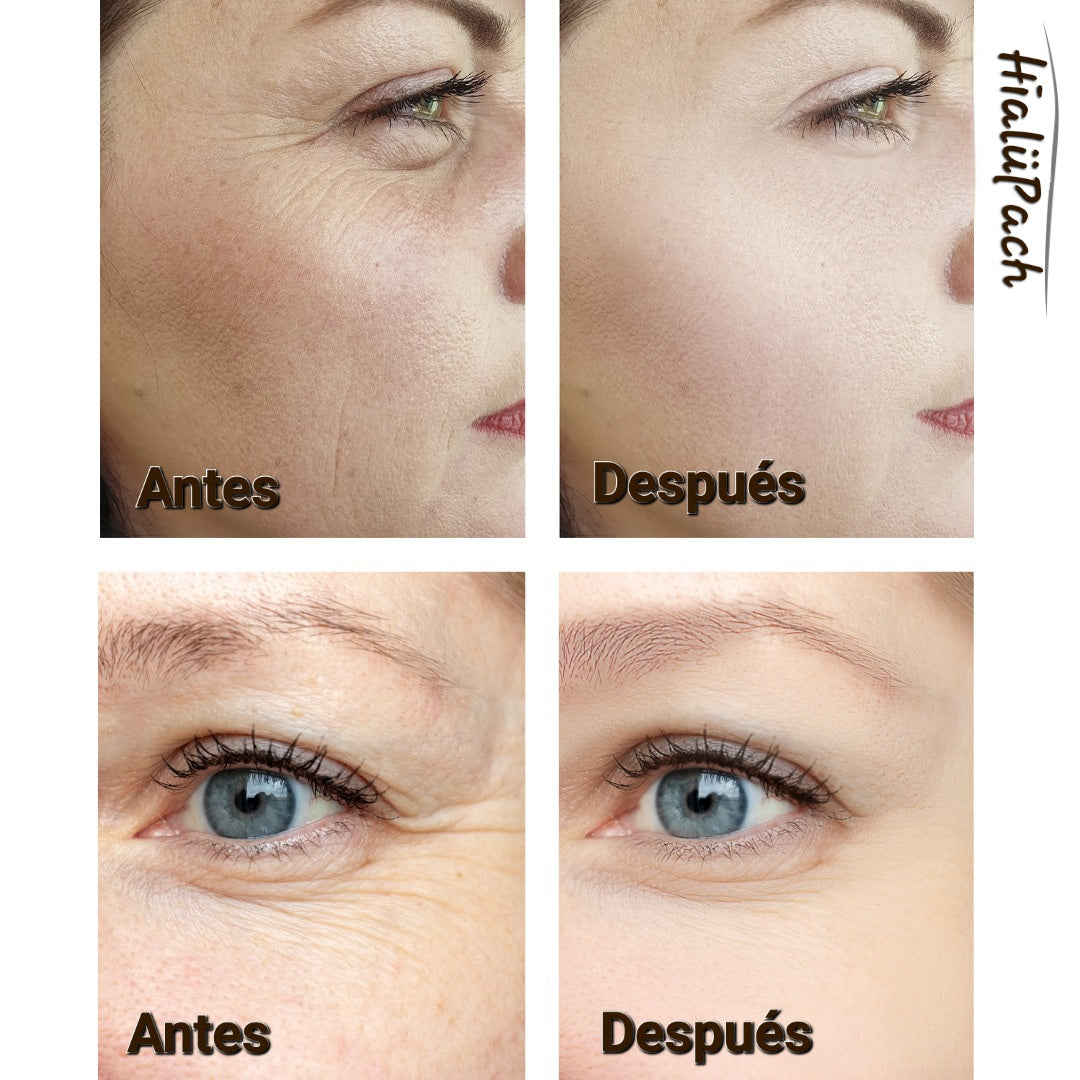 Parches Hyalüpach Colágeno y Acido Hialurónico solubles.